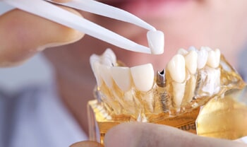 Faccette dentali